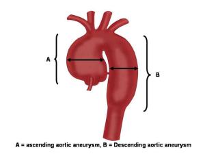 Aneurysm diagram